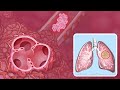 Understanding Non Small Cell Lung Cancer Updated 2025