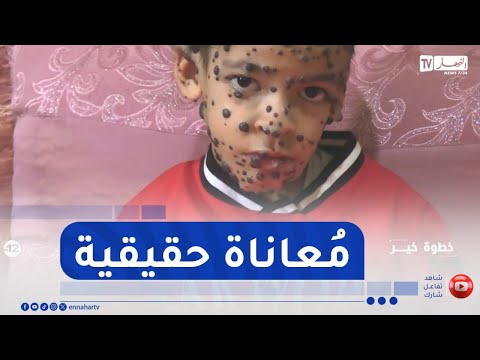 خطوة خير م عاناة حقيقية يعيشها الطفل أنس بسبب ورم دموي إنتشر في جسده 