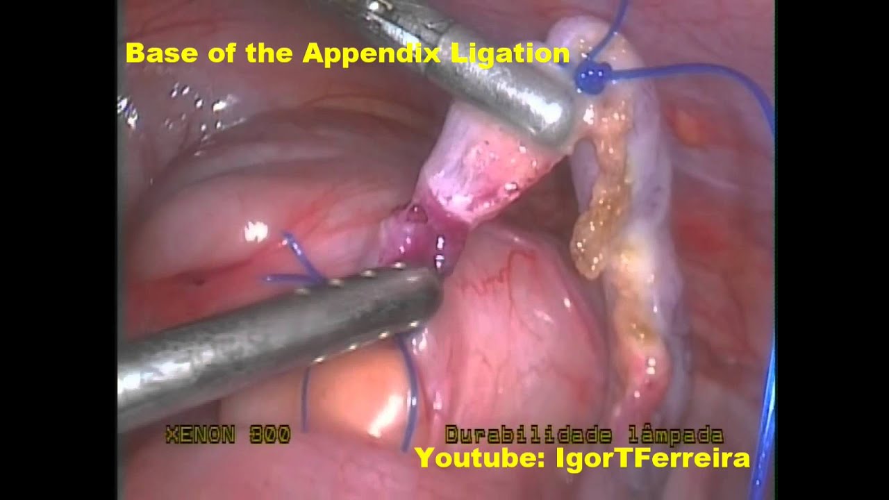 Appendicitis 11 Years Old Girl Initial Stage Youtube