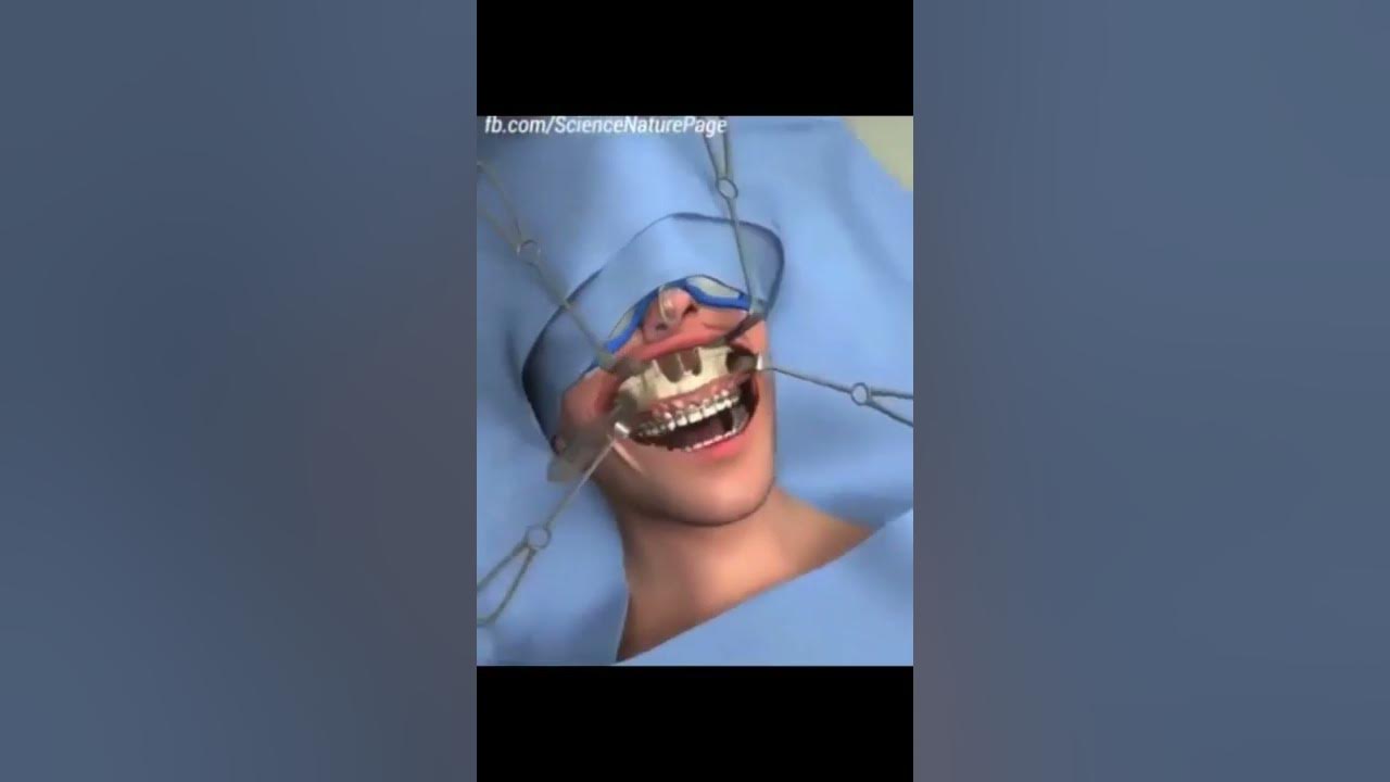AMO Anterior Maxillary Osteotomy Lefort 1, Mid Face maxillofacial surgery Bimax surgery YouTube