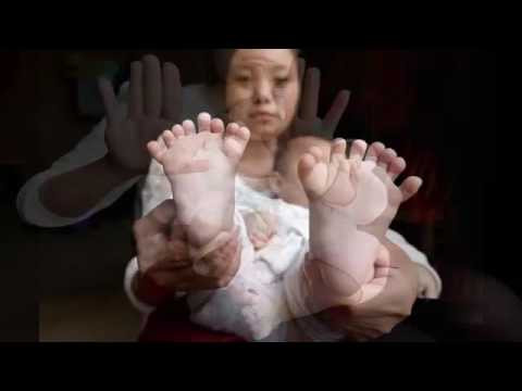 Vídeo: En China, Nació Un Niño Con 15 Dedos Y 16 En Los Pies - Vista Alternativa