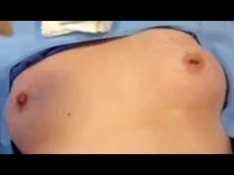 Picture Of Inverted Nipples 89