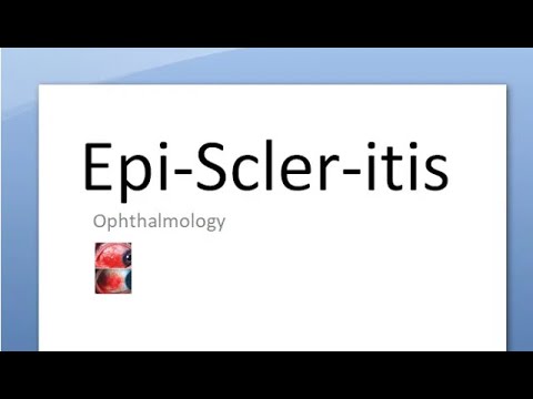 Ophthalmology 150 a EpiScleritis NO PAIN EpiSclera What is