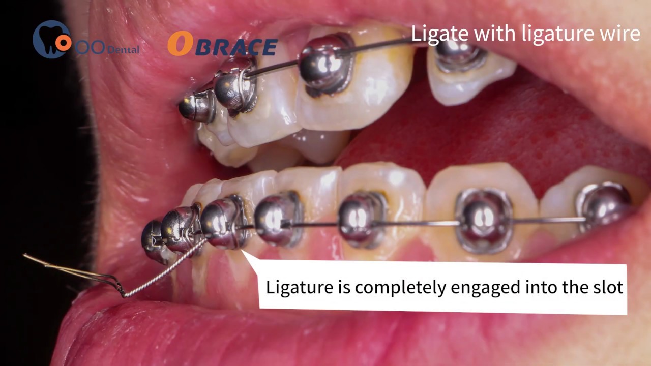 Ligation Method for OBRACE bracket 2 To ligate with ligature YouTube