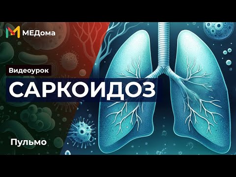Саркоидоз легких: Патогенез, Симптомы, Лечение и Диагностика | Медома | Подготовка к USMLE Step 1