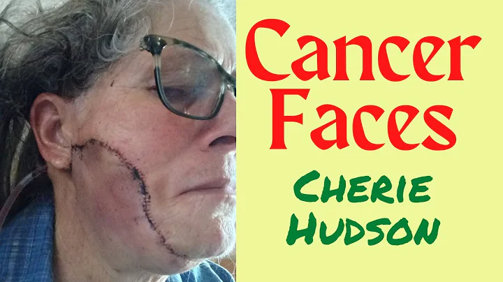 Cherie Hudson's Cancerface Journey with Amelanotic...