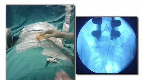 Dr. Georgios Matis - Neuromodulation - Sakrale Nervenstimulation