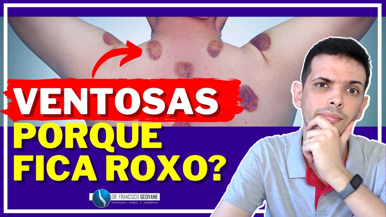 VENTOSATERAPIA - É Normal FICAR ROXO durante a Aplicação das Ventosas ...