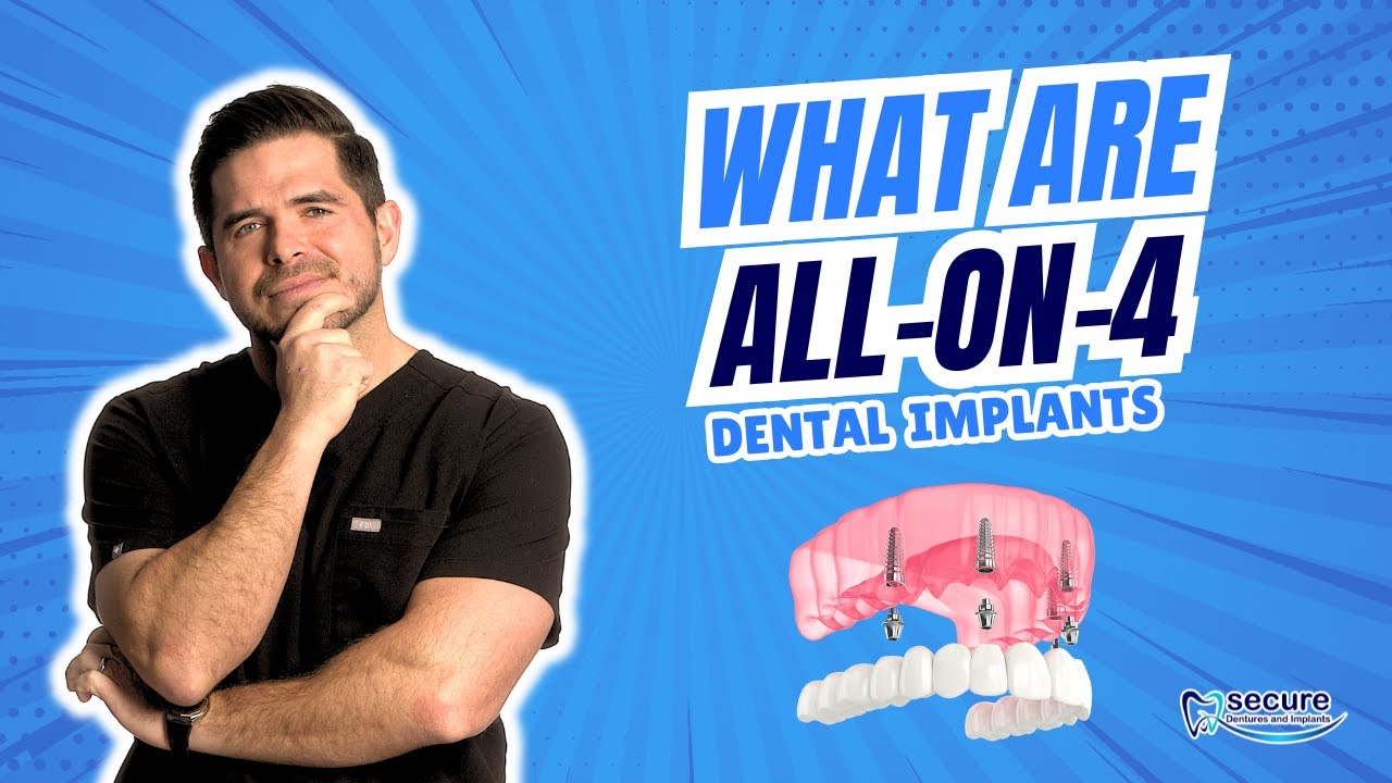 What Are All-On-4 Dental Implants?