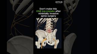 Details Avoid This ONE Big Mistake After Minimally Invasive Spine Surgery News