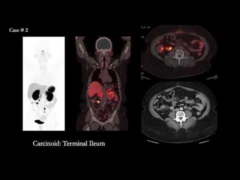 Video: Prima Comparație Intraindividuală A IRM, FET și DOTATOC-PET îmbunătățită De Contrast La Pacienții Cu Meningioame Intracraniene