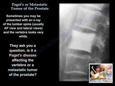 Paget&rsquo;s Or metastatic Tumor Of The Prostate - Everything You Need To Know - Dr. Nabil Ebraheim