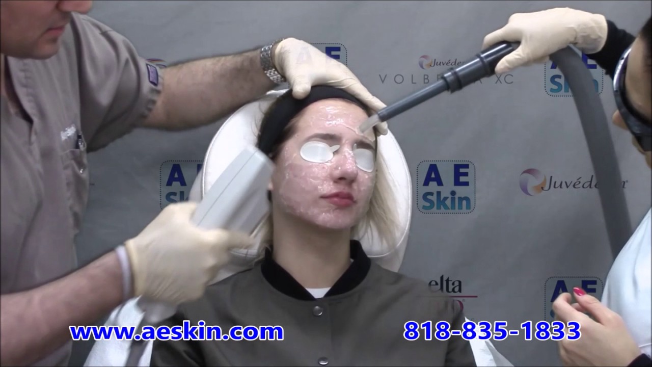 Forever Clear BBL Acne Laser Treatment Demonstration 3 A E Skin