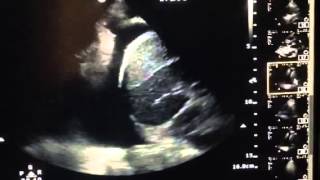 Large Pleural Effusion on Ultrasound