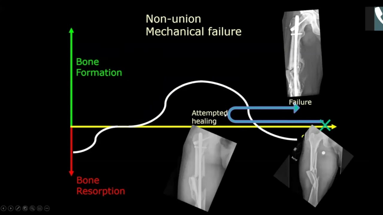 A Unified Theory of Bone Healing and Nonunion—Malcom Smith