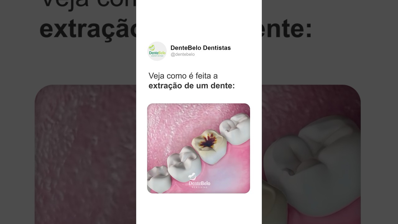 Como é feita a extração de um dente?
