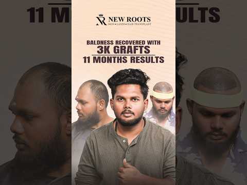 Hair Transplant in Lucknow | 3000 Grafts Hair Transformation #hairtransformation #lucknow #shorts