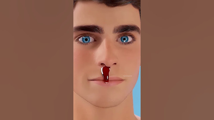 Nigdy Nie Rób Tego Jeśli Dostaniesz Krwotoku Z Nosa 😱