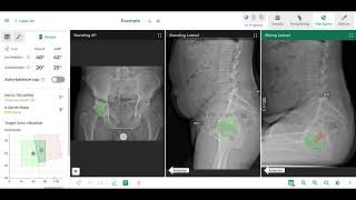 Intellijoint VIEW planning for HIP