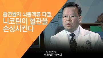 흡연환자 뇌동맥류 파열, 니코틴이 혈관을 손상시킨다  - (2010.12.11_354회 방송)_혈관이 부풀어 오른다, 동맥류