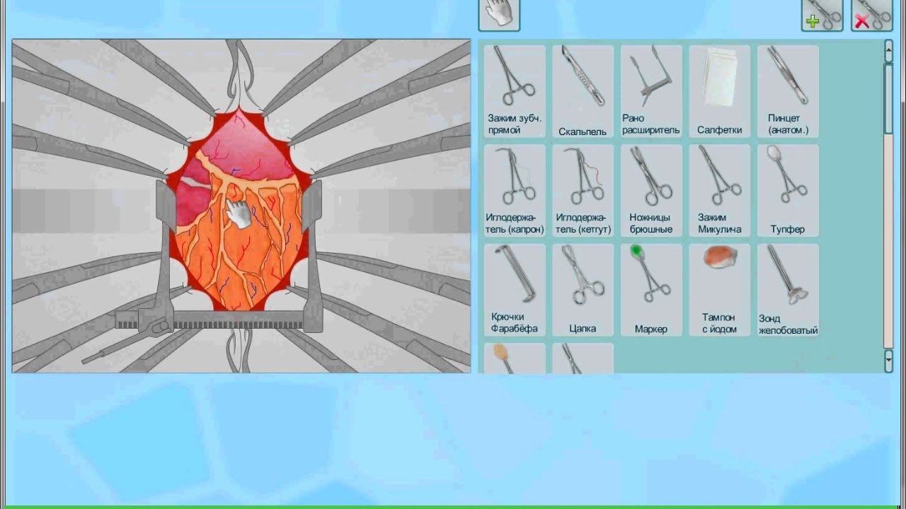 Ушивание язвы желудка - YouTube