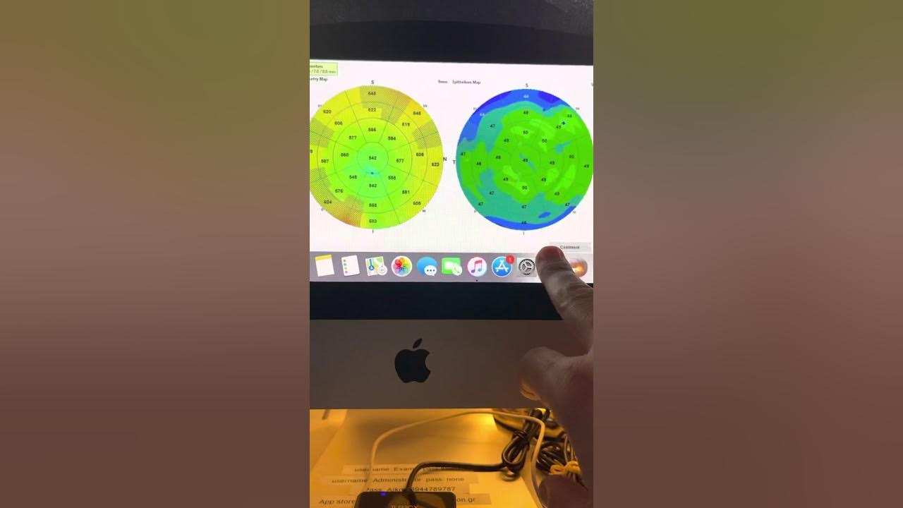 False Keratoconus and Pellucid diagnoses in monocular ectasia secondary