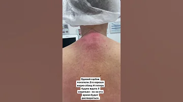 Удаление горба на спине без операции. Вдовий горб. врач Сосина Р.А.