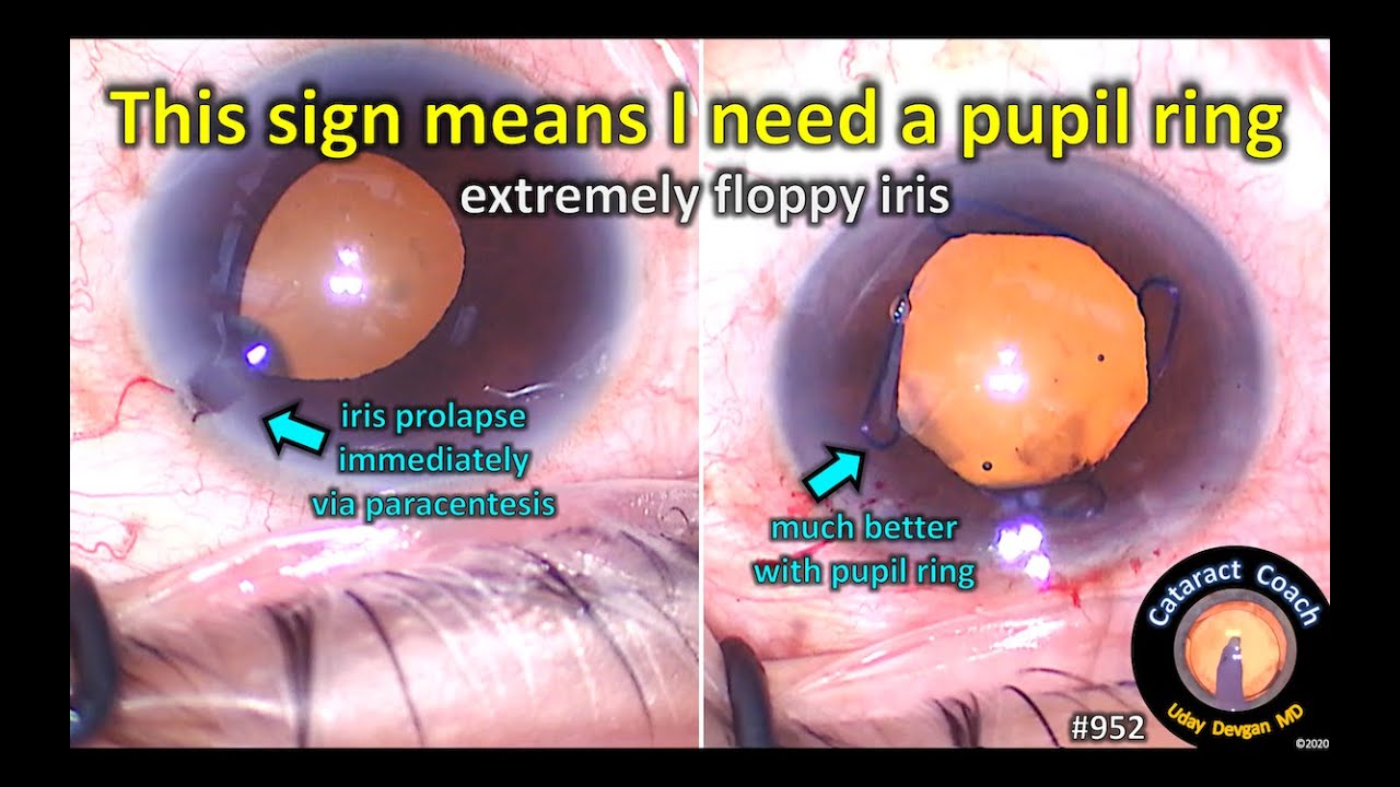 How to use the Malyugin Ring during Cataract surgery with FEMTO LDV Z8 by  Prof. Malyugin - YouTube