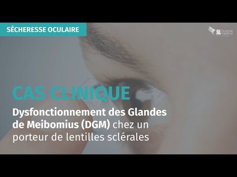 Cas clinique - Dysfonctionnement des Glandes de Meibomius chez un porteur de lentilles sclérales