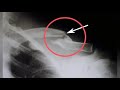NLE PREPARATION Demo, Fracture of clavicle #clavicle #fractureclavicle