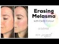 Erasing Melasma with Demi Colour