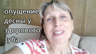 7.Опущение десны у здорового зуба/ Как я лечу