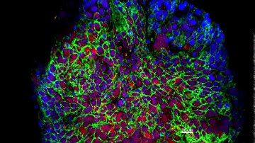 Precision Medicine - 3D Organoid