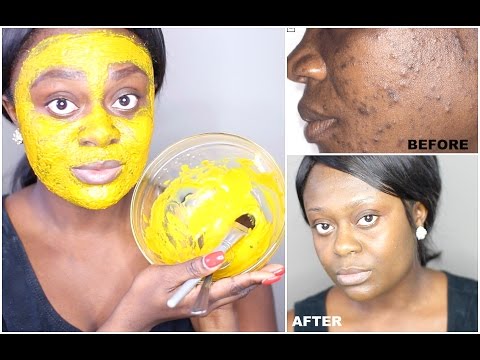 DIY TURMERIC FACE MASK | BEST ACNE TREATMENT | GET CLEAR, BRIGHT AND ACNE FREE SKIN IN  DAYS