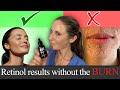 How to get retinol results without the burn- Dermatologist guide