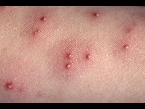 Scabies Rash Information and Guide - Healthy-Skin-Guide.com