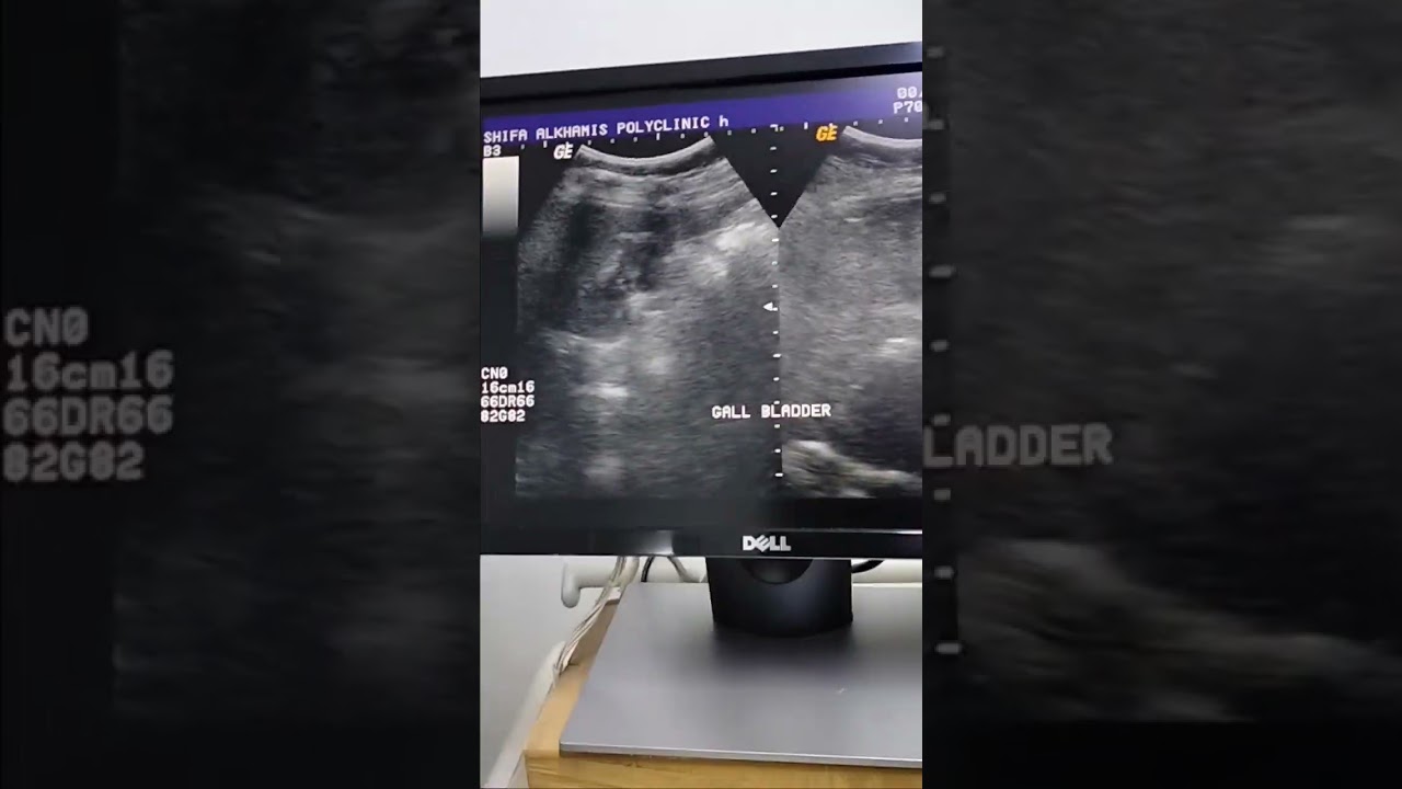 Ultrasound for Gallbladder 