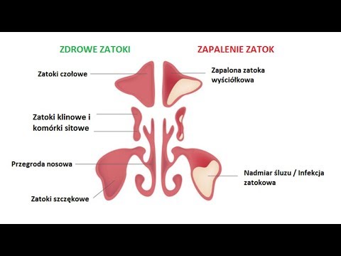 Wideo: Różnica Między Zapaleniem Zatok A Zapaleniem Błony śluzowej Nosa I Zatok