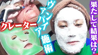 クレーター最新施術を一挙公開！クレーターは綺麗になるのか？！ヴァンパイアフェイシャル！