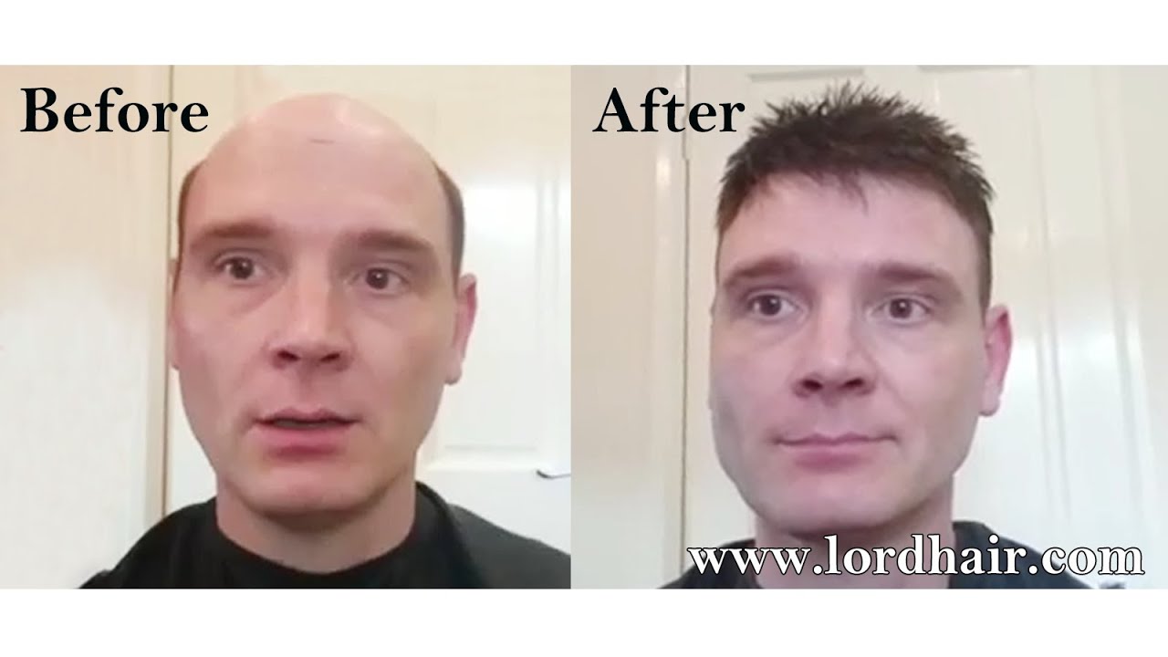 Non Surgical Hair Replacementhair Replacement Systems For Men