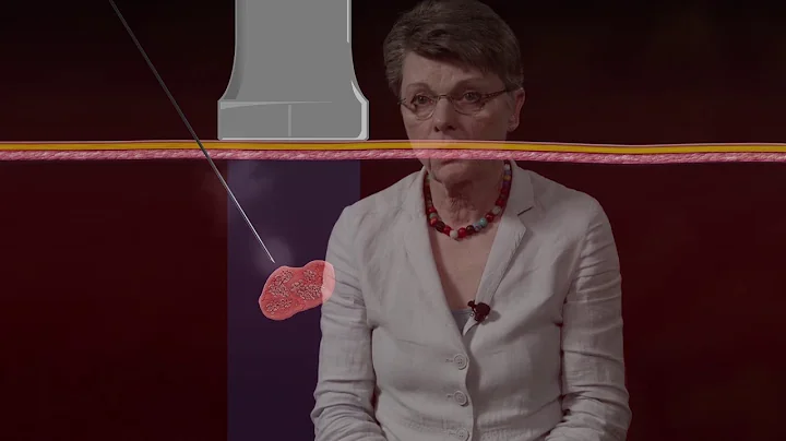 Fine Needle Aspiration Biopsy (FNA) Techniques - Ultrasound Guided FNA Perpendicular Approach