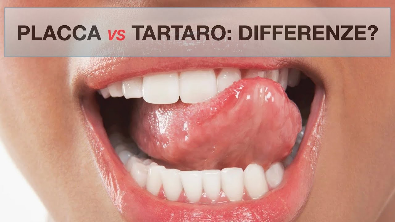 Placca e tartaro: quali differenze?