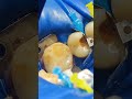 Composite Restoration Upper Second Premolar الكربولة Composite Restoration Upper Second Premolar الكربولة