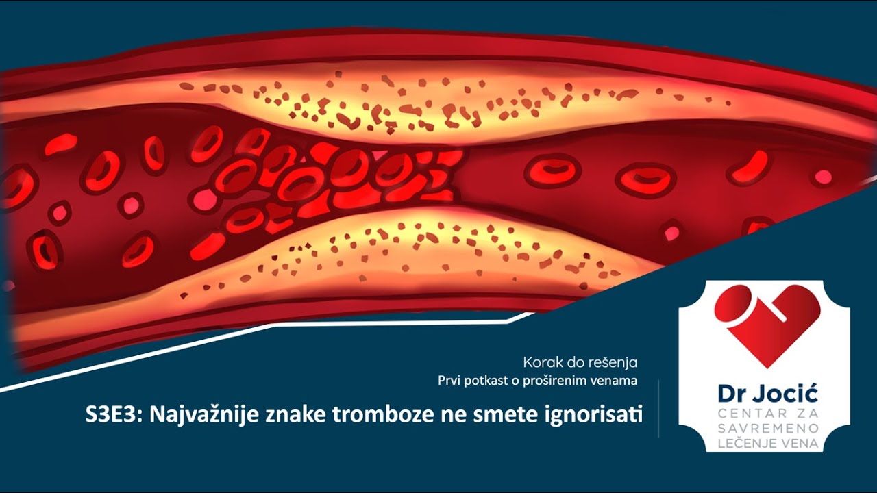 S3E3 Najvažnije znake tromboze ne smete ignorisati