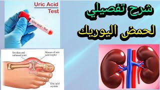 شرح تفصيلي لحمض اليوريك (Uric Acid) وأسباب الزيادة والنقصان، وماهو مرض النقرس (Gout)؟
