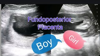 Fundoposterior placenta | Anterior placenta means baby boy? | Posterior placenta means baby girl?