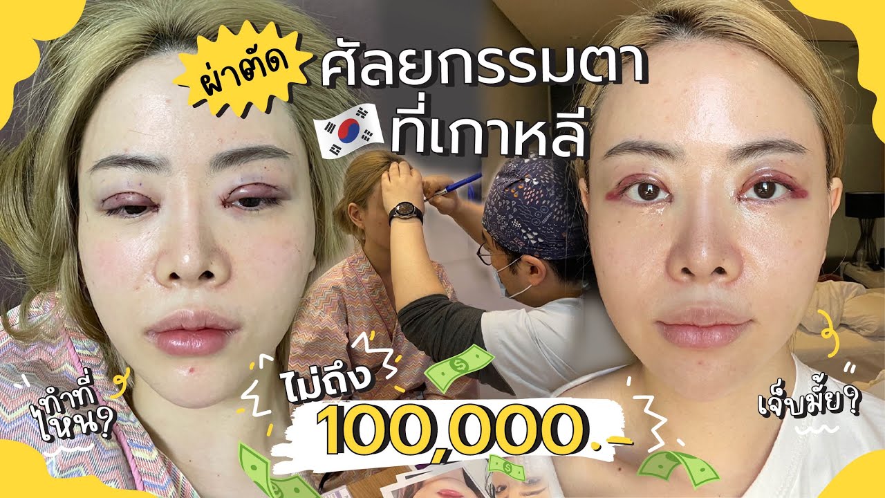 ผ่าตัดศัลยกรรมตาที่เกาหลี Ep.2 ไม่ถึง100,000บาท Beauty Surgery | Jane  Soraya - Youtube