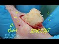 Back Cyst Removal. Dr Khaled Sadek. LipomaCyst.com