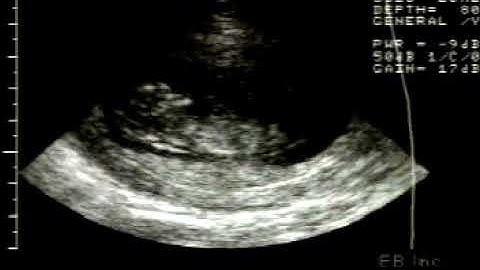 Chorionic Villus Biopsy