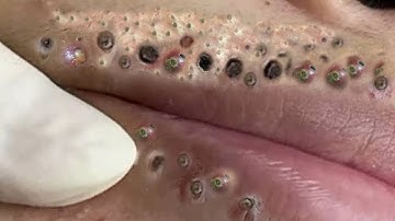 Best Blackhead Removal Ever 15min - Facial Acne Treatment #pimples